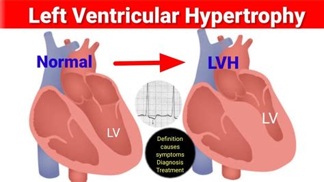 lv hypertrophy meaning|causes left ventricular hypertrophy.